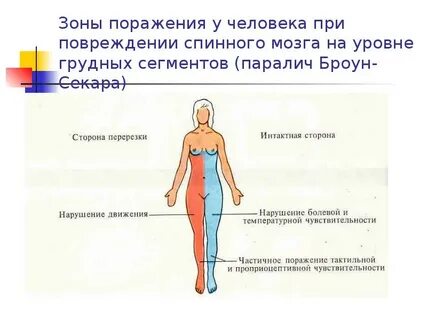 Уровни травм спинного мозга