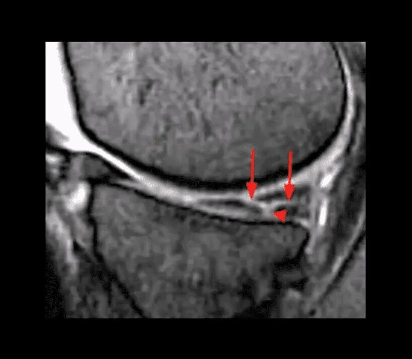Разрыв мениска мрт. Экструзия мениска коленного сустава мрт. Параменисковая киста латерального мениска. Мрт разрыв заднего рога мениска. Разрыв латерального мениска Stoller 3a что это такое.