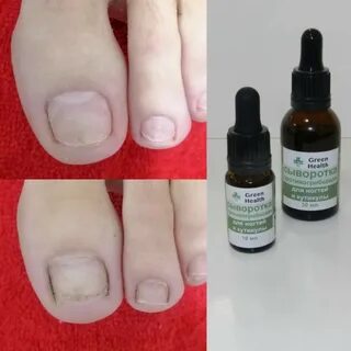 Онихолизис ногтей лечение лаком