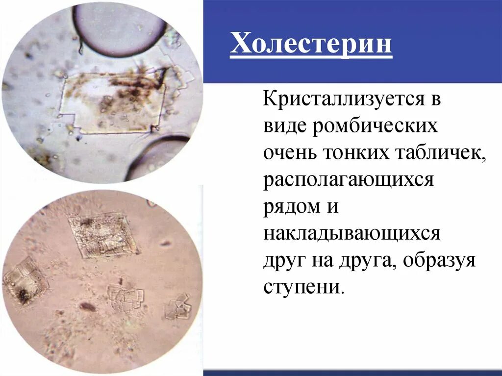 Почему в моче осадки. Микроскопия кала трипельфосфаты. кристаллы холестерина в желчи микроскопия. холестерин в моче микроскопия. осадок мочи микроскопия.