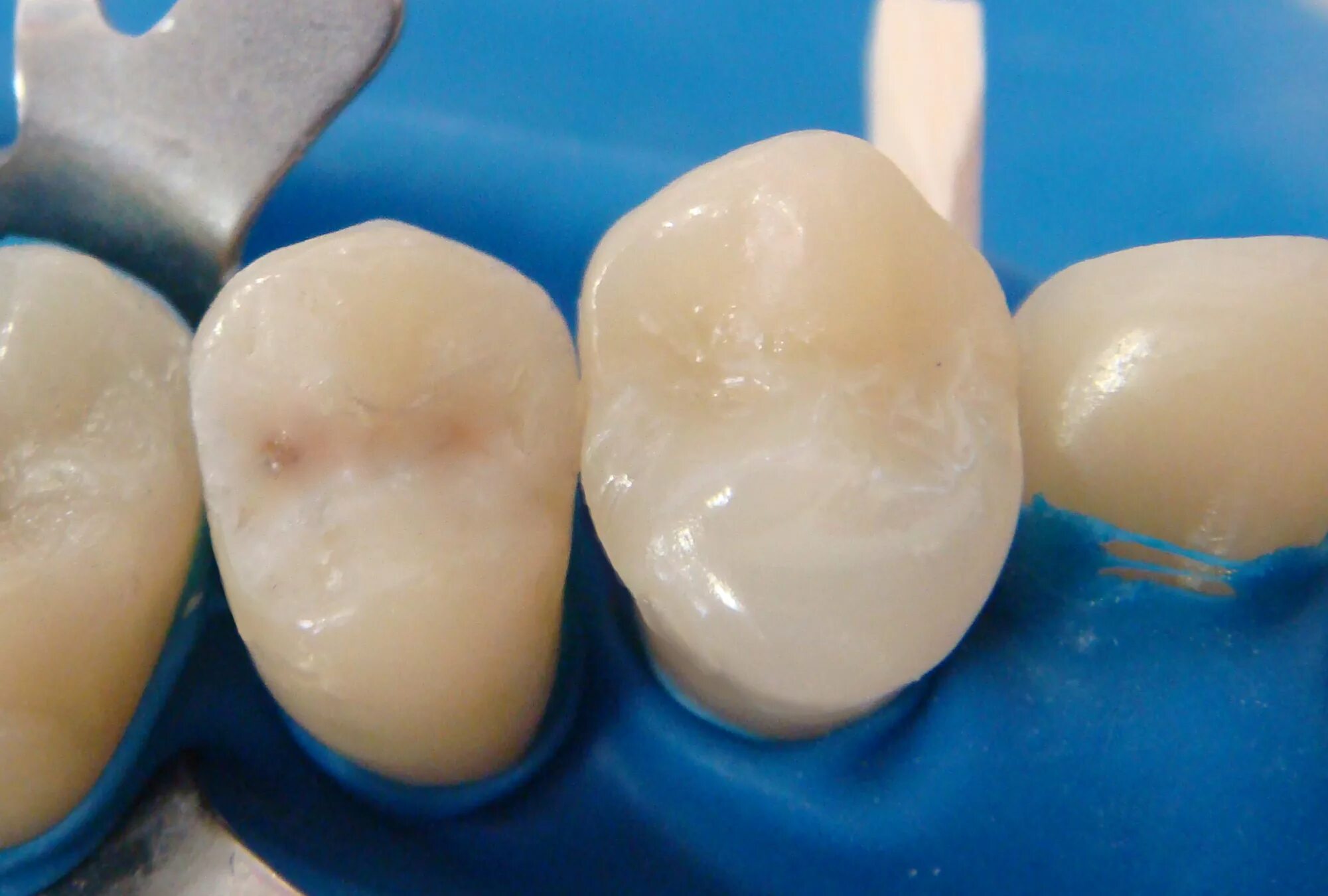 Стекловолоконный штифт культя зуба. Использование стекловолоконного штифта. Штифт стоматологический стекловолоконный. Материал для установки стекловолоконных штифтовых. Углеродоволокнистые штифты в стоматологии.