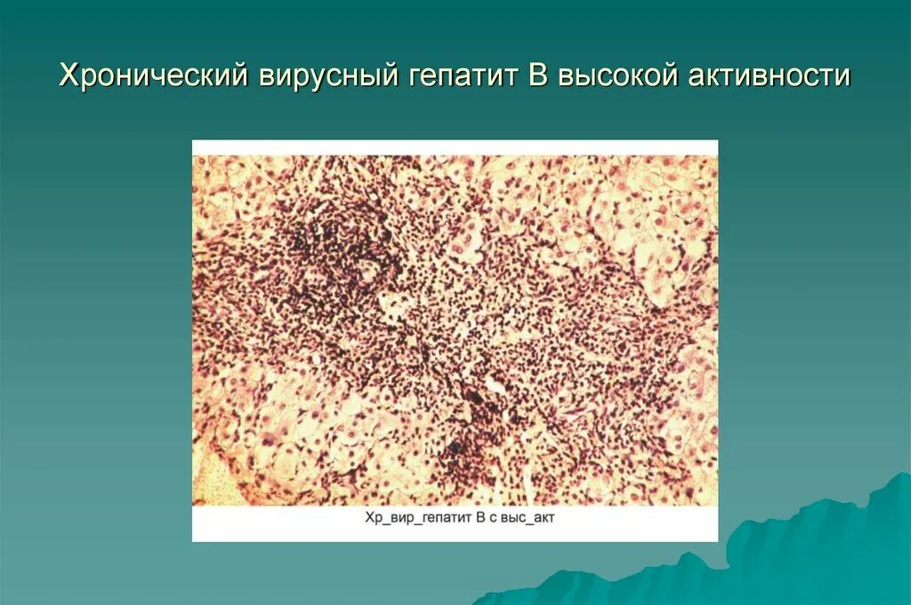 Тяжелая форма вирусного гепатита. Хронический активный вирусный гепатит микропрепарат. Хронический активный вирусный гепатит микропрепарат рисунок. Хронический вирусный гепатит с. Вирусный гепатит микропрепарат.