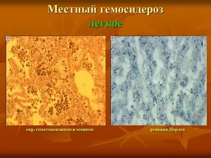 Гемосидероз это