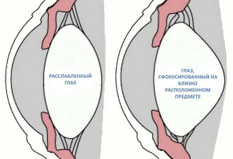 Снятие аккомодации. Спазм аккомодации. Спазм аккомодационных мышц. Спазм внутриглазной мышцы. Спазм аккомодации глаз.