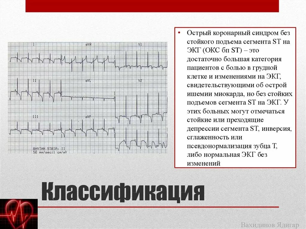 Острым коронарным синдромом без. Острый коронарный синдром ЭКГ. Окс с подъёмом St клинические рекомендации ЭКГ. Острый коронарный синдром без подъема сегмента St ЭКГ. ЭКГ инфаркт миокарда без подъема St.