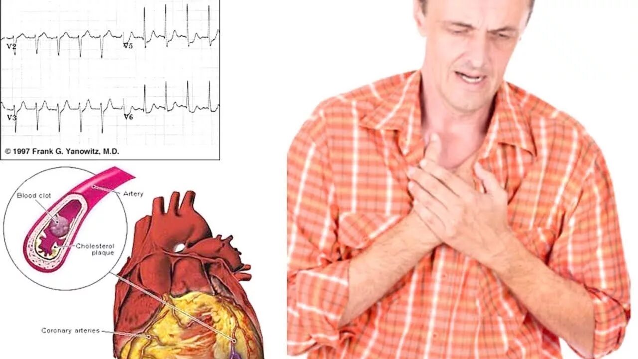 Инфаркт у молодых. Руденко инфаркт. Инфаркт у молодых. Электроды экг при декстрокардии. Руденко инфаркт.