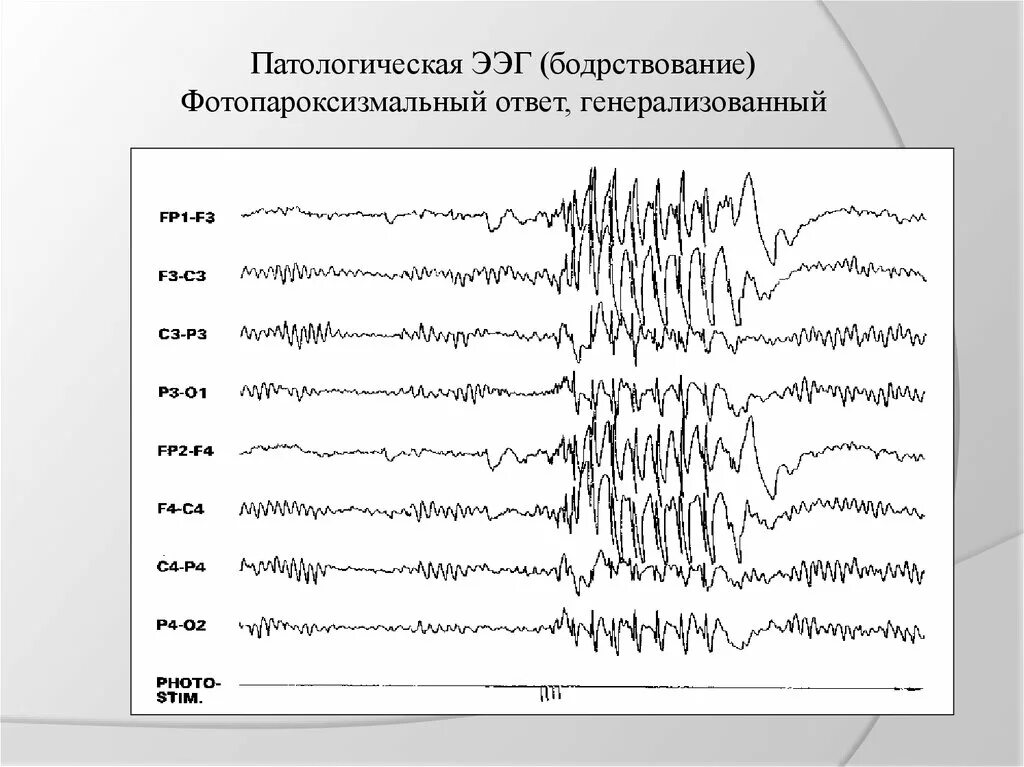 Как выглядит ээг