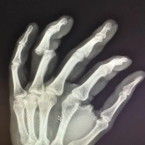 Открытый перелом фаланги. Перелом пястной кости мизинца. Перелом мизинца рентген. Перелом пястной кости 5 пальца. Перелом фаланги пальца рентген.