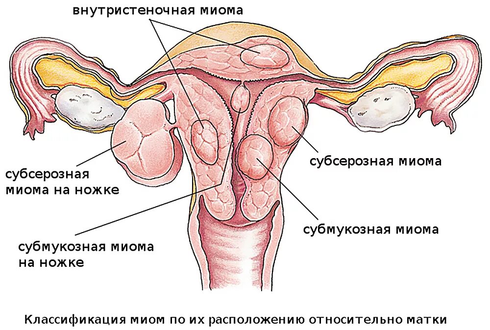 Лейомиома матки что это. Классификация миом по их расположению относительно матки. Субмукозная миома матки.