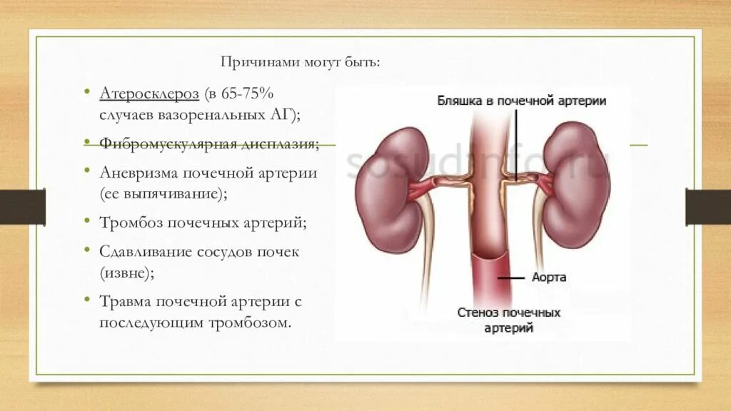 Аневризмы почечных артерий. Аневризма артерий почек. Мешотчатая аневризма почечной артерии. Аневризма аорты почечной артерии. Тромбоз почечных вен