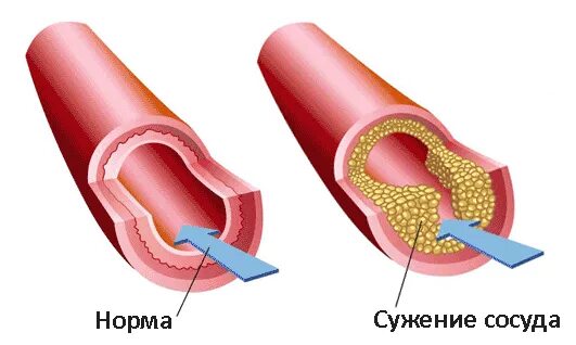 Сужение артериальных сосудов