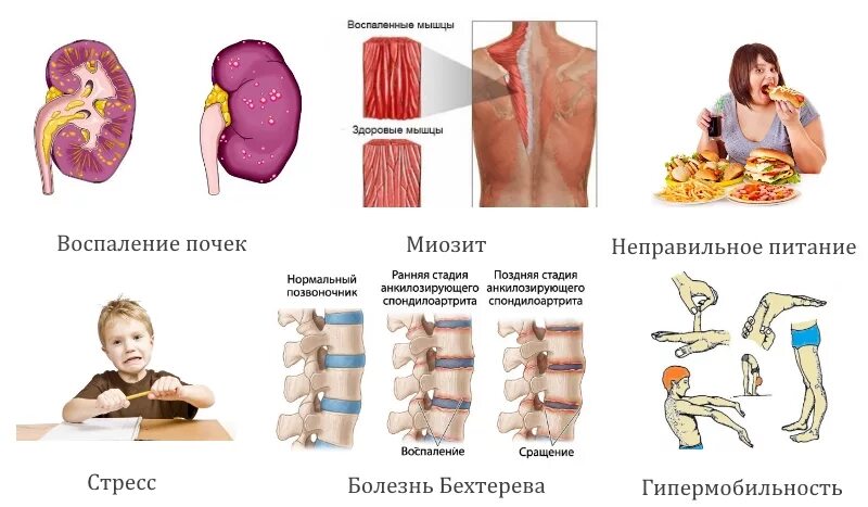 Боль в спине у детей. У ребенка болит поясница. Болит спина у ребенка. Причины болей в спине у ребенка.