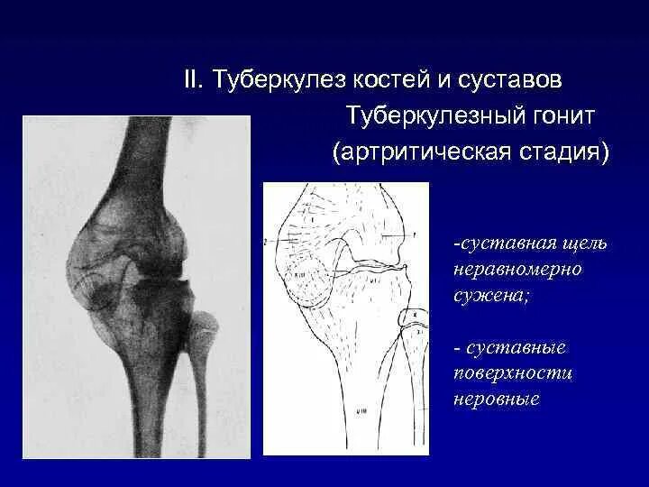 Коленный туберкулез