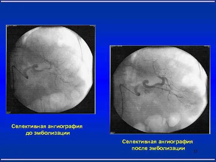 Эмболизация гемангиомы. Эмболизация гемангиомы