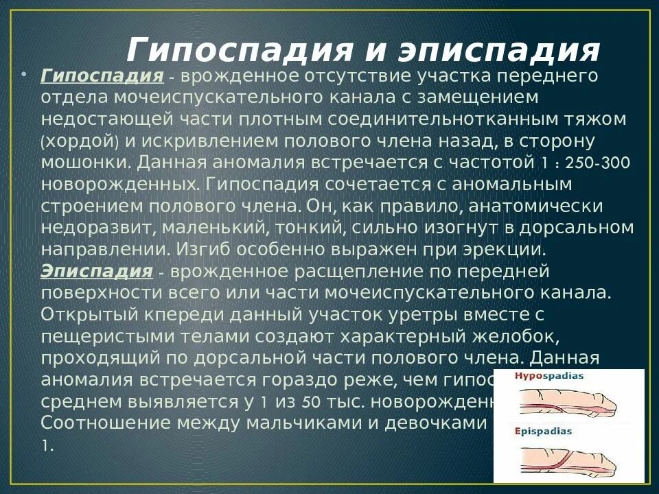 Эписпадия