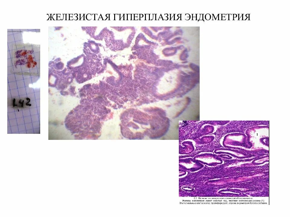 Железисто-кистозная гиперплазия эндометрия микропрепарат. Железистая гиперплазия гистология. Гиперплазия эндометрия гистология. Гиперплазия эндометрий гистология.