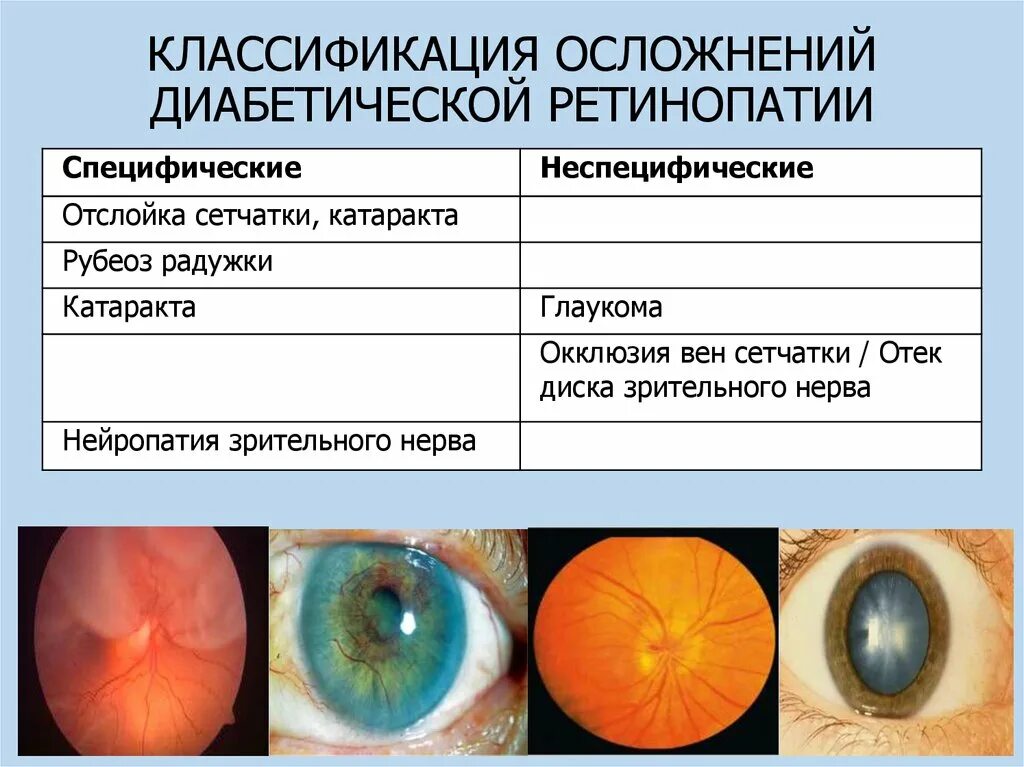 Диабетическая ретинопатия сетчатки. Диабетическая ретинопатия осложнения. Диабетическая ретинопатия глаз. Пролиферативная диабетическая ретинопатия классификация. Классификация глаукомы