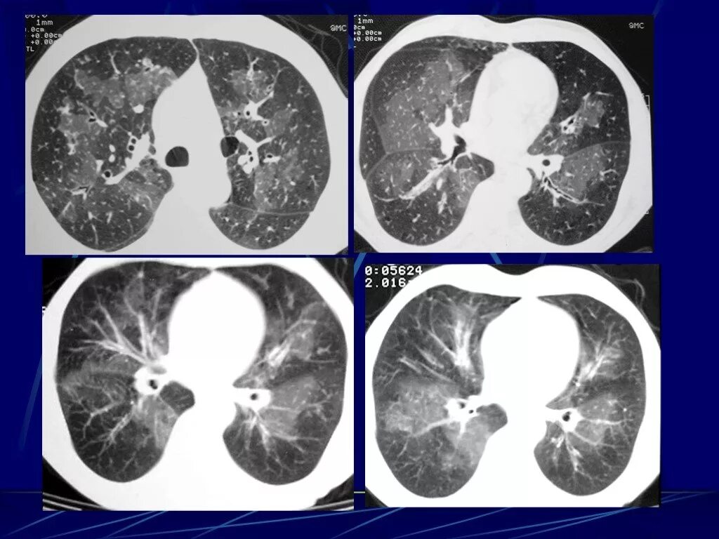 Интерстициальная пневмония на кт. Острая интерстициальная пневмония кт. Интерстициальный отек легких кт. Интерстициальный отёк лёгких на кт. Застойные изменения в легких