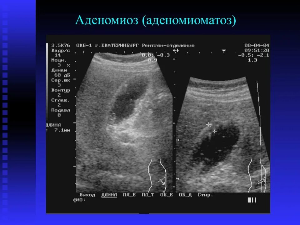 Изменение стенок желчного пузыря. Аденомиоматоз желчного пузыря кт. Холестероз желчного пузыря эхограммы. Аденоматозный полип желчного пузыря мрт. Холестероз желчного пузыря на кт.
