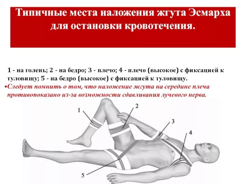 Сколько держать артериальный жгут. Жгут Эсмарха на АК-74. Наложение жгута на бедр. Наложение жгута при кровотечениях.