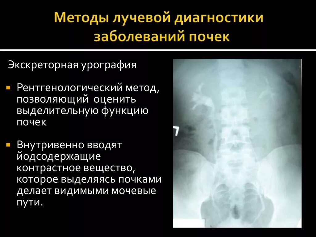 Болезнь почек диагноз. Метод диагностики почек. Методы и заболевания о почек в лучевой диагностике. Методы лучевой диагностики мочевыделительной системы. Методы обследования при заболеваниях почек.