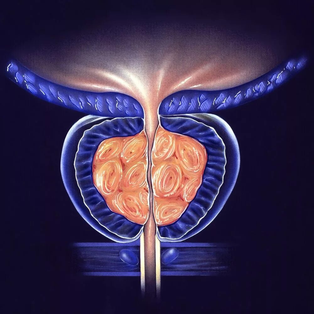 Предстательная железа, Prostata. Простатит предстательной железы. Аденома предстательной железы. Мочеиспускание при простатите у мужчин