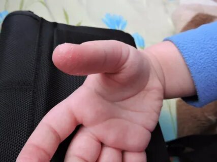 Колит подушечку пальца
