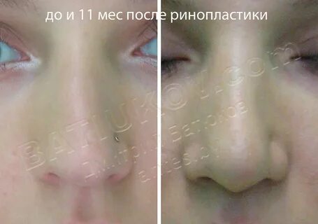 Ринопластика отек сколько