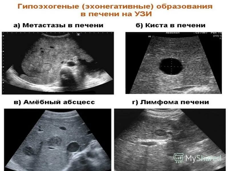 Вылечить метастазы в печени. Метастазы в печени на УЗИ на УЗИ. УЗИ печени при метастазах.