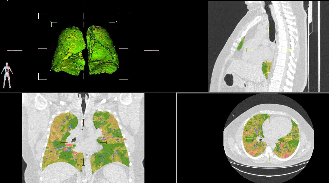 3 поражения легких. Легкие пораженные коронавирусом на кт. Кт снимки легких при коронавирусе. Поражение легких при кт коронавирус.