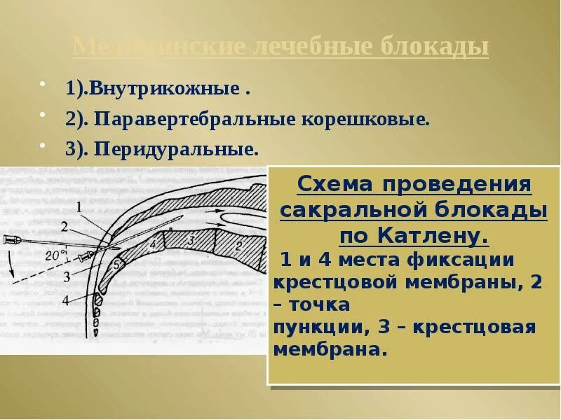 Техника выполнения блокады поясничного отдела. Методика проведения паравертебральной блокады. Техника выполнения паравертебральной блокады. Паравертебральная блокада методика выполнения.