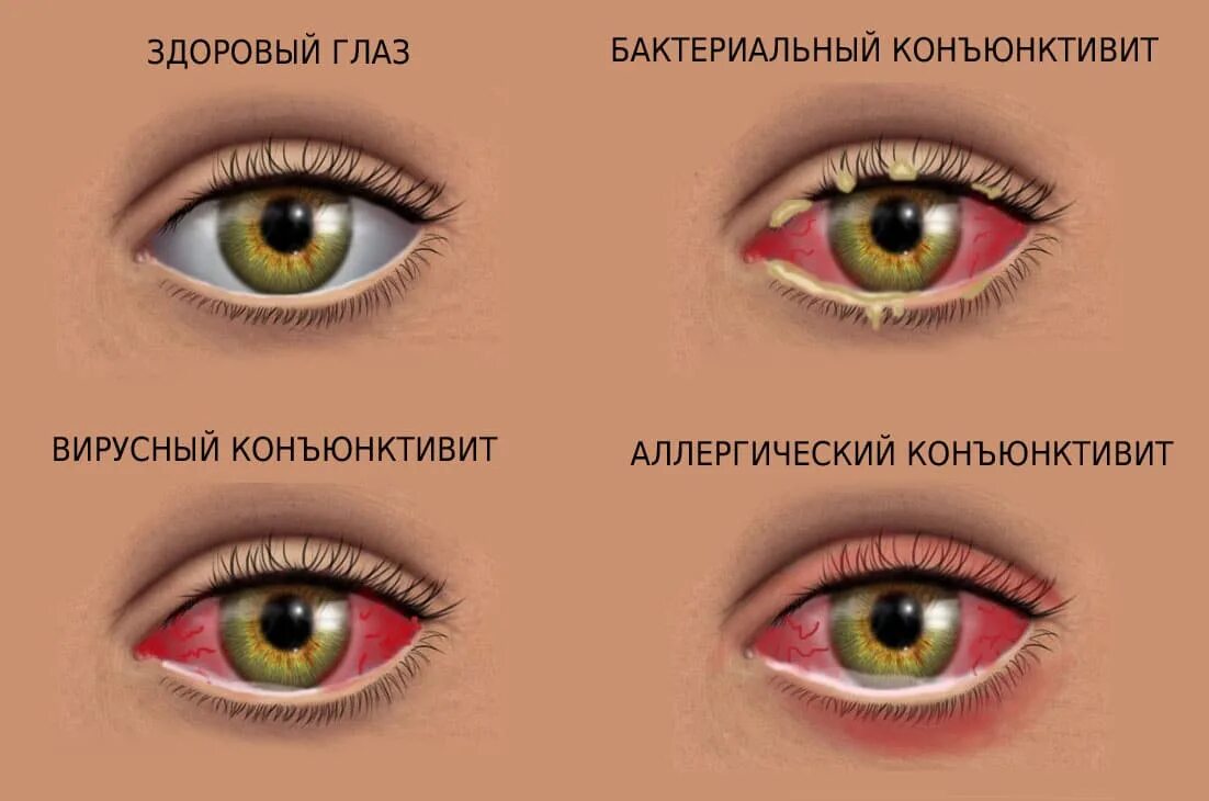 Коньюктивит у ребенка 4. Бактериальный конъюнктивит глаз. Герпетический вирусный конъюнктивит. Конъюнктивит у взрослых симптомы. Вирусный конъюнктивит симптомы.