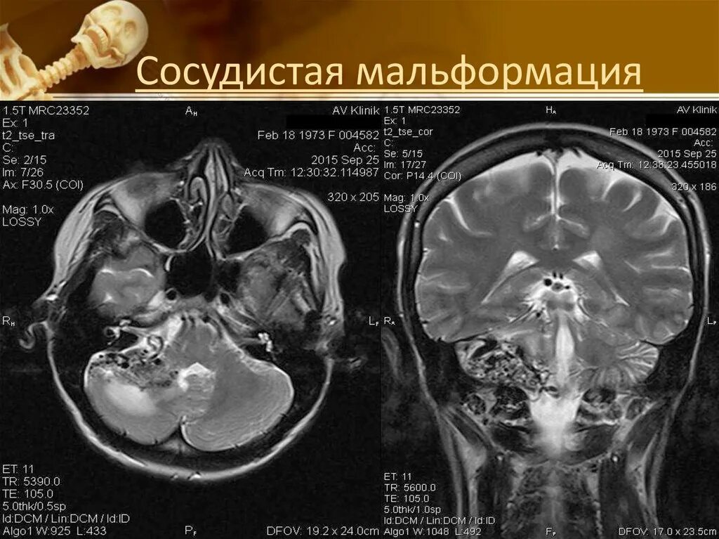 Сосудистая аномалия. Сосудистая мальформация мозжечка. Артериовенозная мальформация мозжечка. Венозная мальформация гемисфере мозжечка это. Мальформация мозжечка мрт.