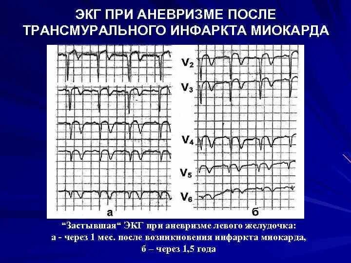 Постинфарктный кардиосклероз симптомы