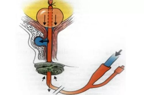 Промывают мочевой пузырь у мужчин. Катетеризация и промывание мочевого пузыря. Промывание катетера мочевого пузыря алгоритм. Раствор для промывания мочевого пузыря через катетер. Промывание мочевого пузыря через катетер Фолея.