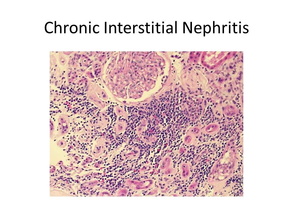 Nephritis значение термина. Pathogenesis of tubulointerstitial nephritis.