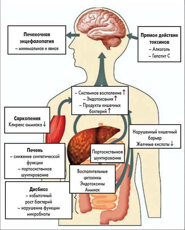 Лечение алкогольного цирроза печени. Печеночная энцефалопатия клинические симптомы. Патогенетическая терапия печеночной энцефалопатии. Синдром печеночной энцефалопатии этиология. Механизм развития печеночной энцефалопатии при циррозе печени.