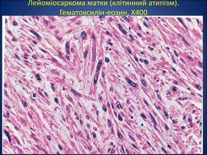 Лейомиосаркома