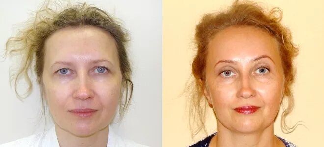 Эндоскопическая подтяжка лба и бровей. Эндоскопическая подтяжка лба и бровей. Эндоскопическая подтяжка лба. Эндоскопическая подтяжка лба отзывы фото до и после. Эндоскопический лифтинг лба отзывы с фото до и после.