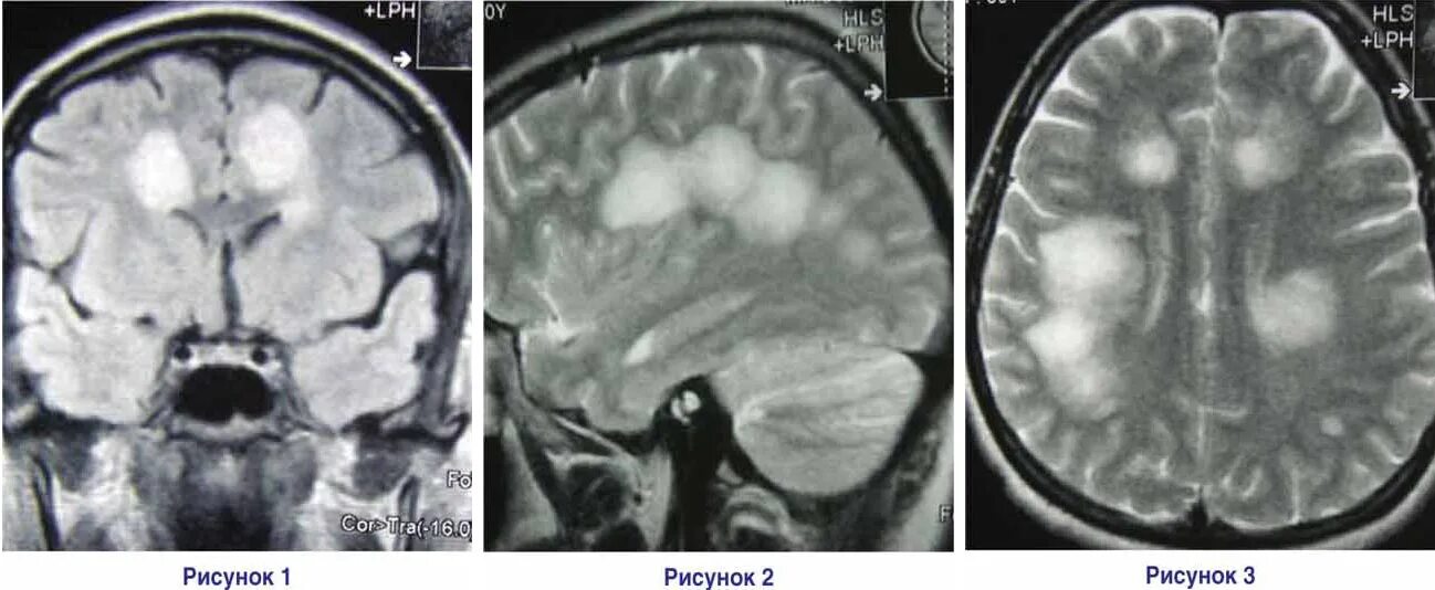 Диффузное поражение головного. Токсоплазмоз головного мозга мрт. Токсоплазменный энцефалит на мрт. Токсоплазмозный энцефалит мрт.
