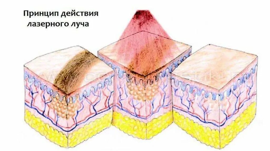 Элементы кожной сыпи лихенификация. Вторичные элементы сыпи трещина. Вторичные морфологические элементы кожи лихенификация. Усиление кожного рисунка. Лихенификация дерматовенерология.