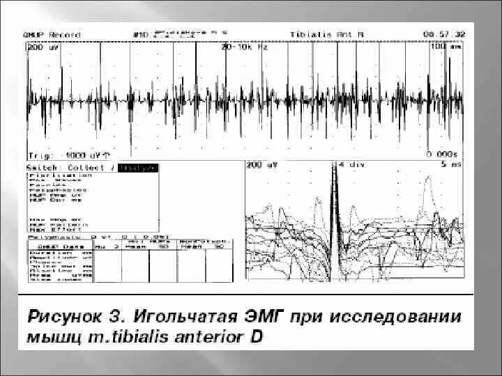 Эмг сайт. Игольчатая электромиография схема. энмг нижних конечностей игольчатая. игольчатая электромиография (эмг). расшифровка игольчатой электромиографии.