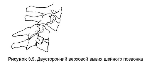 Подвывих позвонка мкб. Подвывих с1 шейного позвонка рентген. подвывих сустава крювелье симптомы. верховой подвывих шейного позвонка. вывих с2 позвонка.