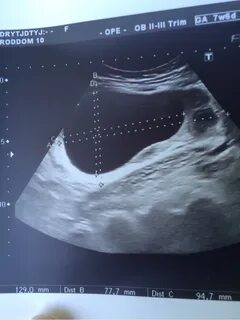 Узи показало овуляцию