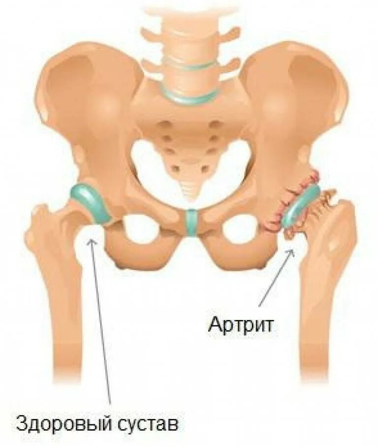 Больной сустав тазобедренный. Патологии тазобедренного сустава артрит. Коксит тазобедренного сустава. Коксит тазобедренного сустава у детей.
