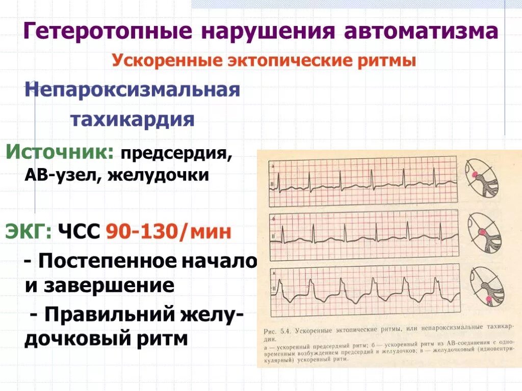 Непароксизмальная тахикардия ЭКГ. Ускоренные эктопические ритмы. Непароксизмальная тахикардия ЭКГ предсердная. Ускоренные эктопические ритмы (непароксизмальная тахикардия). Эктопический предсердный ритм что это