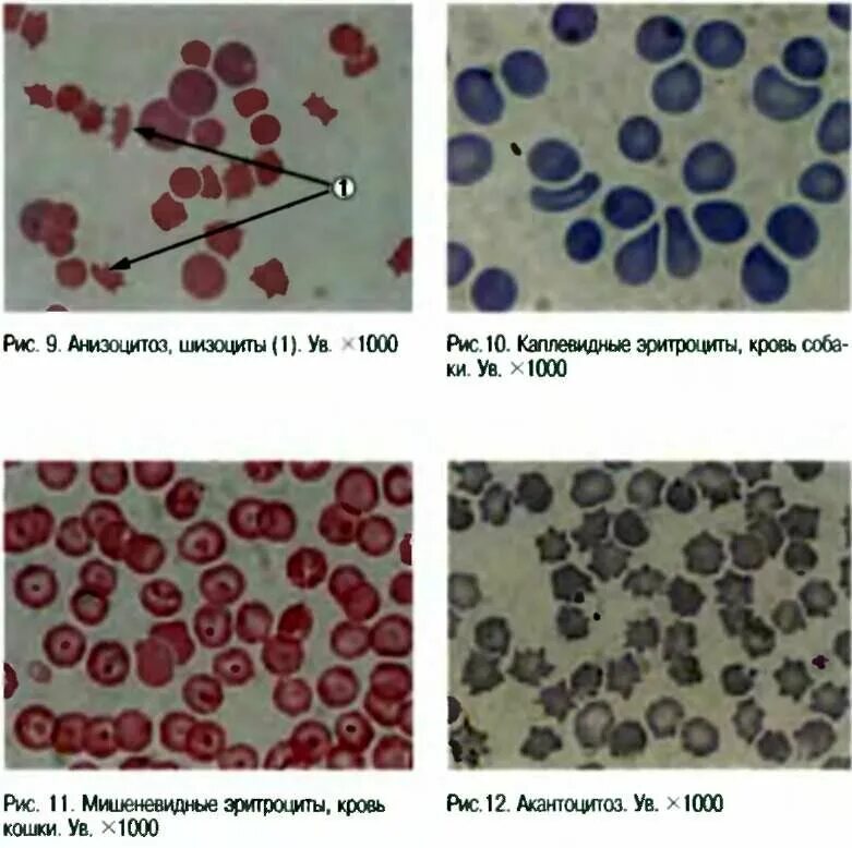 Лейкоциты мазок крови. Микроскопия окрашенного мазка крови. Гемолитическая анемия эритроциты. Цитологическое исследование эритроциты. Цитологическое исследование лейкоциты норма.