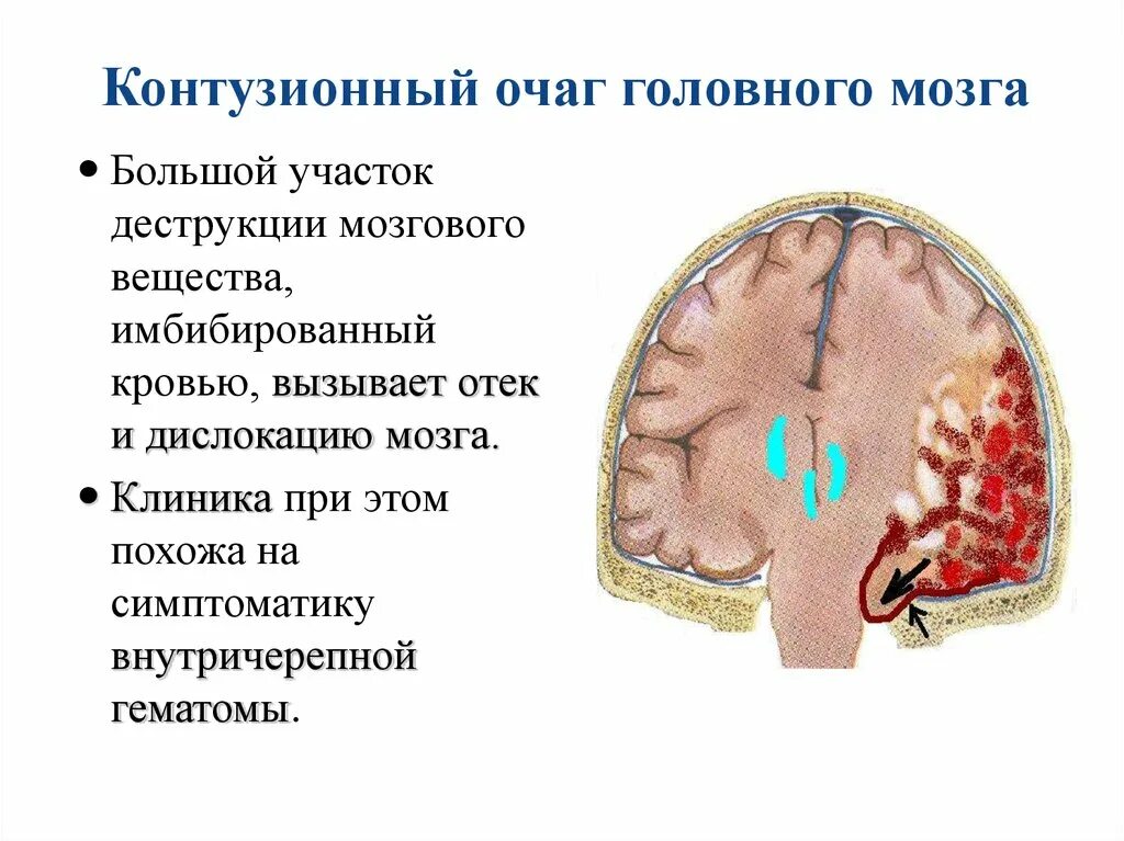 Мелкие очаги в головном мозге. Контузионные очаги головного мозга. Контузионные очаги головного мозга типы.