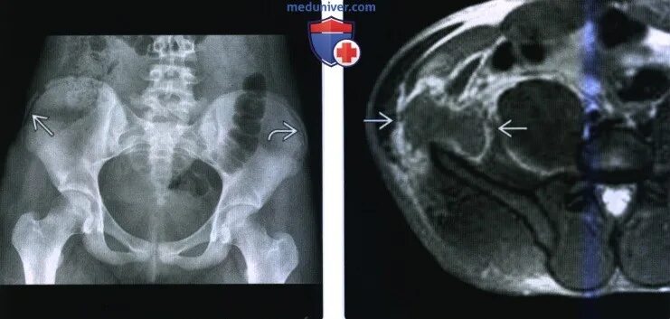 Кт подвздошной кости. Опухоль подвздошной кости рентген. Остеома подвздошной кости на мрт.
