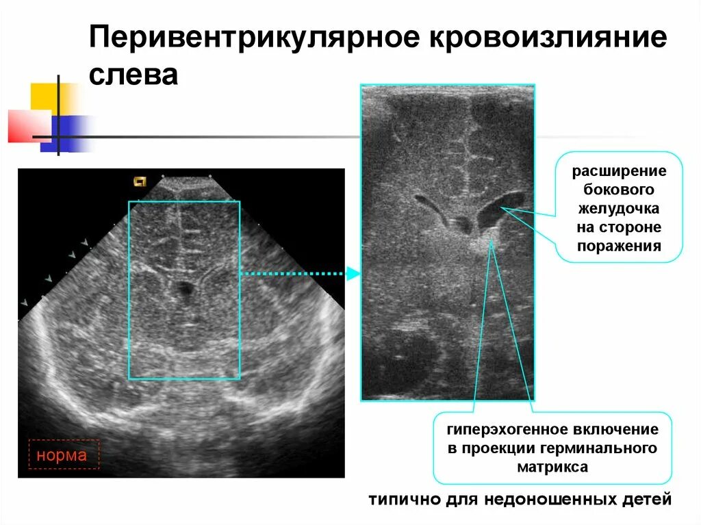 Внутрижелудочковое кровоизлияние кт. Перивентрикулярное кровоизлияние у новорожденных 1 степени. Субэпендимальное кровоизлияние УЗИ. Расширение желудочков дети